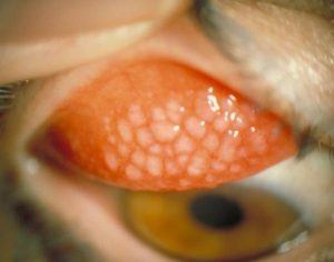 Congiuntivite allergica-Infermiere di territorio-ECM